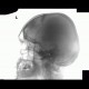 Fissure of skull, epidural hematoma: X-ray - Plain radiograph